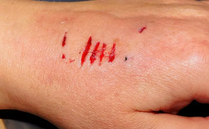 Dog bite hand