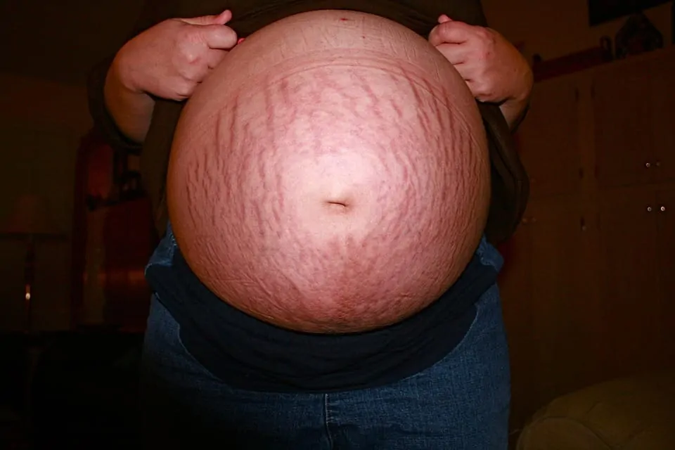 prgnancy stretch marks